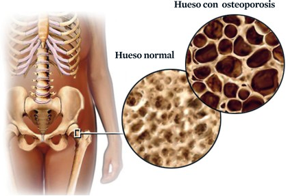Ostoporeosis afecta a millones de personas: ISSSTE