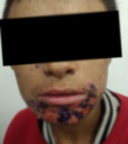Pareja torturó con ácido muriático a  adolescente por casi un año en Aguascalientes