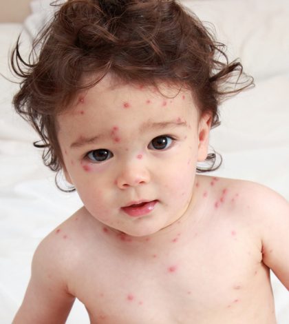 Epidemia de varicela en San Luis Potosí; suman ya 415 casos