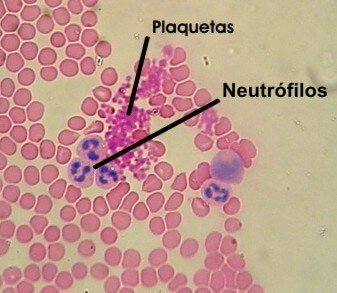 Plaquetopenia,  alteración en la coagulación