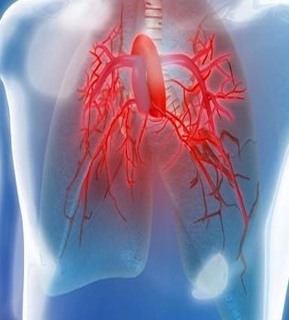 La Hipertensión Pulmonar es un grupo de enfermedades catastróficas