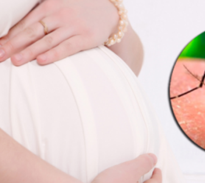 SLP registra ya 20 caso de zika, 16 de ellos en embarazadas