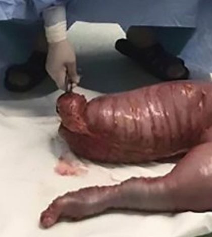 Médicos extraen 12 kilos de heces de un hombre constipado desde nacimiento