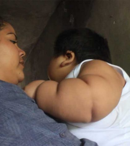 Bebé de 10 meses pesa 30 kilos, podría tener Síndrome de Prader-Willi