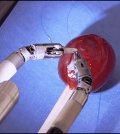 Un éxito, la primera cirugía robótica de tórax en hospital de México