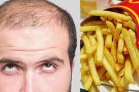Sustancia de las patatas fritas de McDonald’s podría curar la calvicie