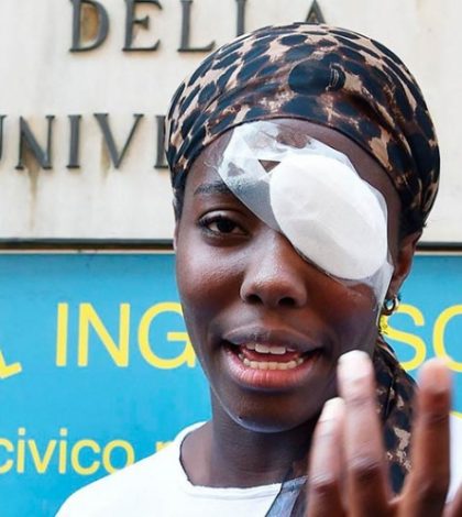 Atacan a atleta de origen africano; le lesionan un ojo
