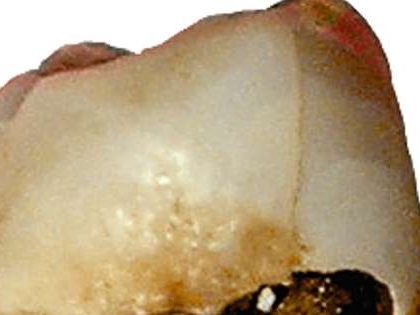 Encuentran 1.000 dientes podridos de principios del siglo XX en Australia