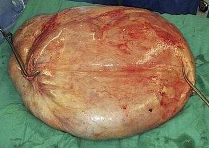 Mujer sobrevive tras extirpación de tumores de 35 kilos, en la India