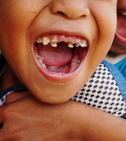 Le extraen más de 500  dientes a niño de 7 años en India