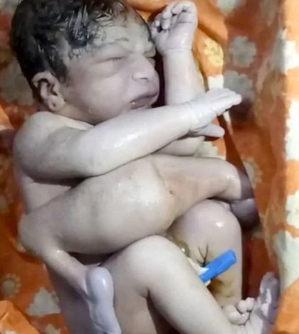Médicos salvan la vida a bebé que nació con 3 piernas