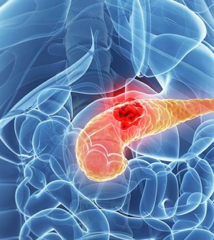 Cáncer de páncreas podría tratarse con nanopartículas según estudio