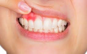 7 señales de alerta de que podrías padecer gingivitis